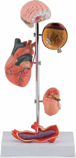 Effects of Hypertension 5 parts